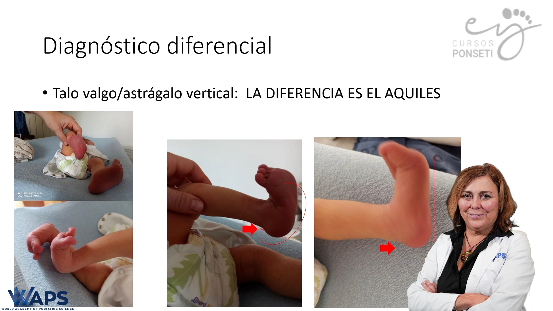CLASS - TALUS VALGUS AND VERTICAL TALUS: CONCEPT, CLINICAL, DIAGNOSIS AND  TREATMENT - WAPS - World Academy of Podiatric Science